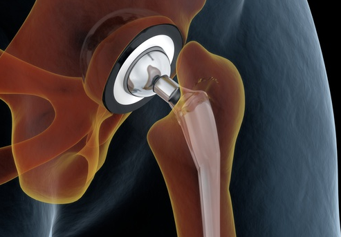 Protesi dell'anca l'intervento chirurgico quando è necessario