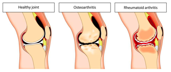 cartilagine e artrosi