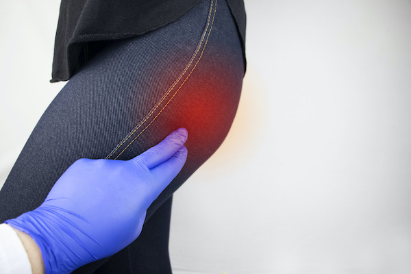 A woman suffers from pain in the buttock. The doctor diagnoses the patient piriformis syndrome, pinch of the sciatic nerve, lumbar osteochondrosis or sciatica